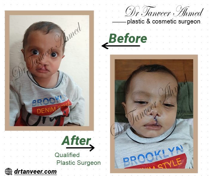 Cleft Lip Surgery