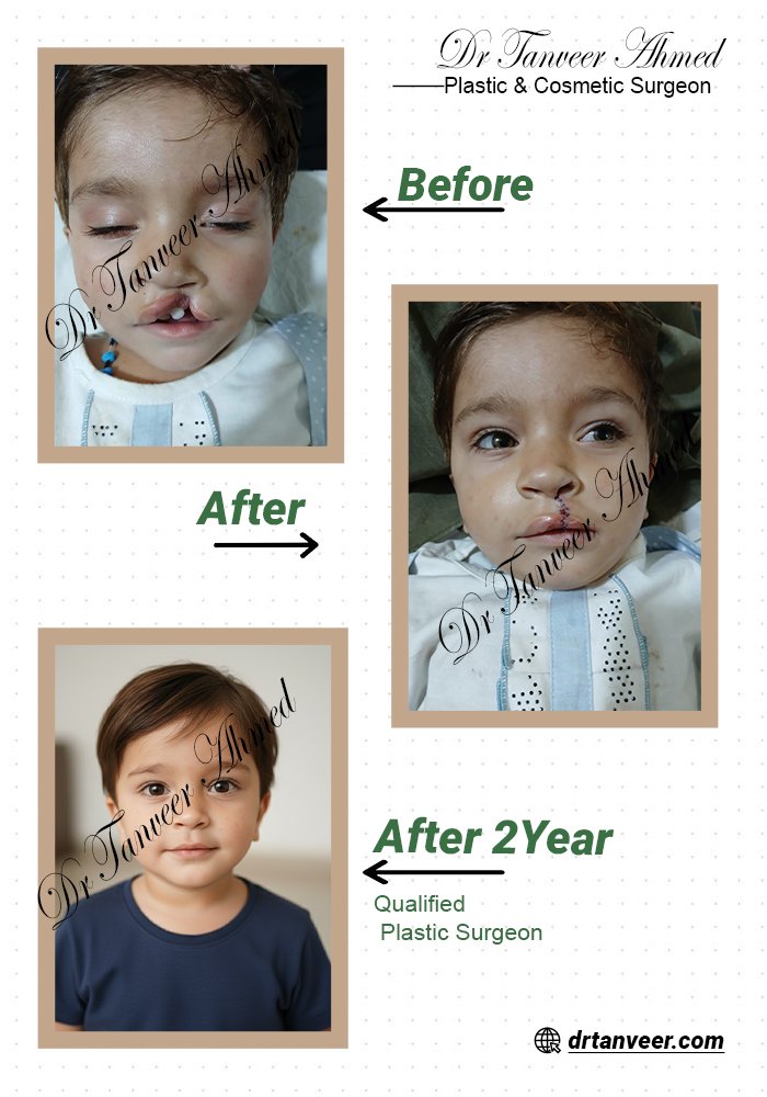 Cleft Lip Surgery
