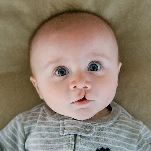 Cleft Lip Surgery