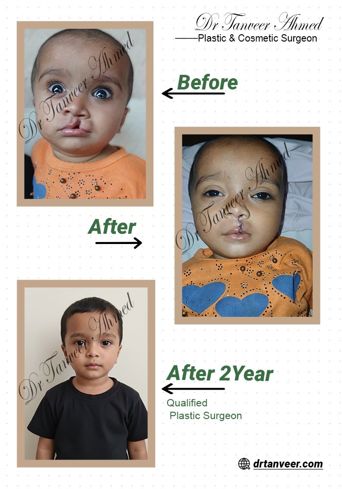 Cleft Lip Surgery