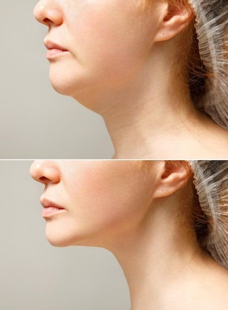 Neck Lift