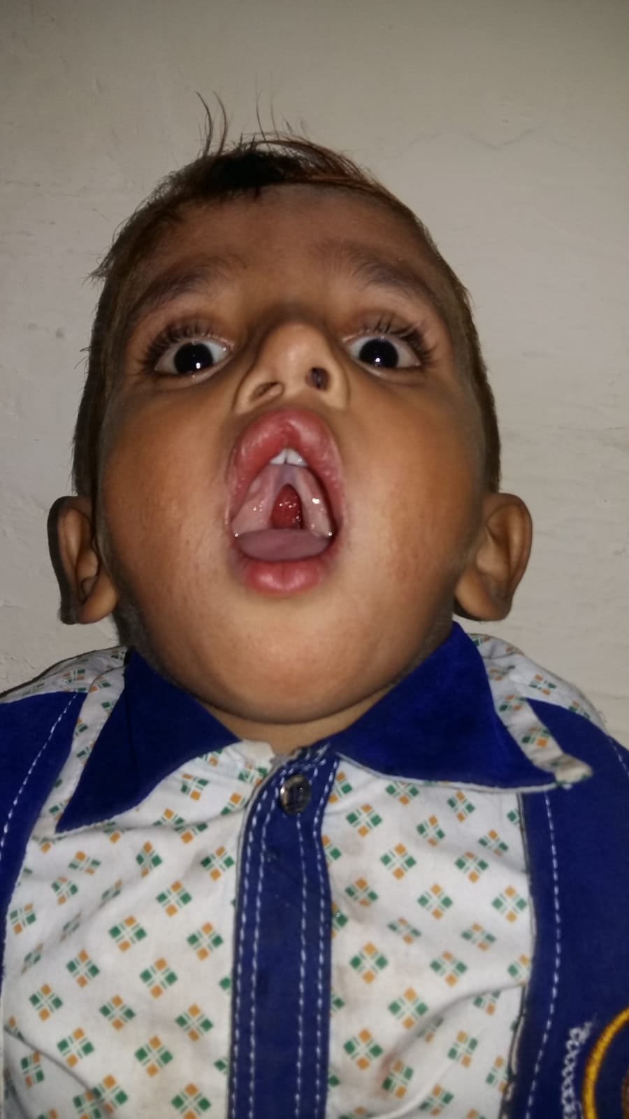 Cleft Palate